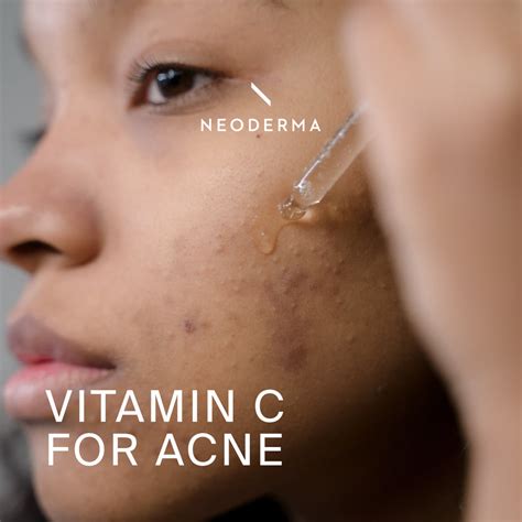 Vitamin C For Acne | Vitamin C And Acne For Pimples| NEODERMA