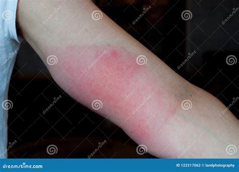 Machucado Inchado E Vermelho - Dano Vermelho Do Braço Alergia Da Pele Foto de Stock - Imagem de ...