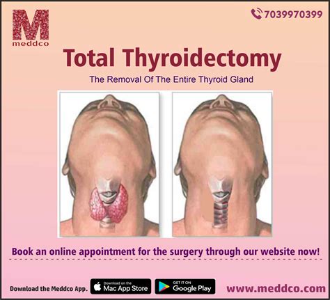 How to prepare for a Total thyroidectomy surgery?