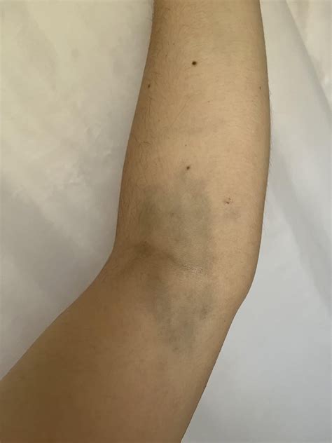 bruises after getting blood drawn : r/medical