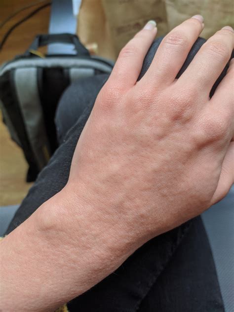 Any Cold Urticaria owners? : r/urticaria
