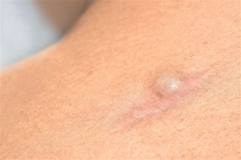 epidermal sebaceous skin cyst epidermoid cyst removal  singapore