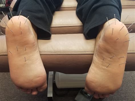 Dry Needling | Align Spine Health Center, LLC