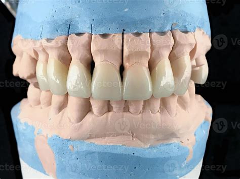 Dental porcelain prosthesis implant tooth in dental laboratory. Front