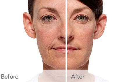 radiesse hobgood facial plastic surgery