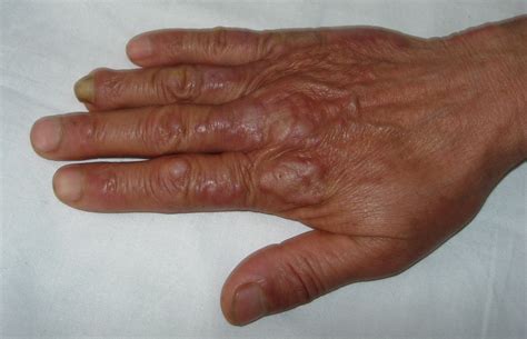 Erythema Elevatum Diutinum Images Erythema Elevatum Diutinum: