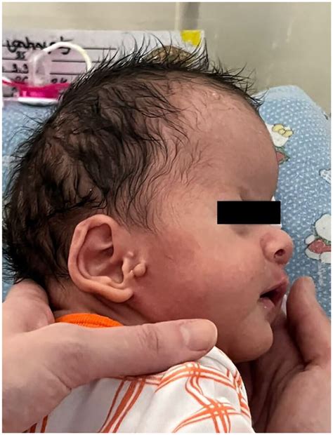 pfeiffer syndrome acrocephalosyndactyly  significant syndactyly