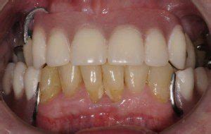 partial dentures  pics dental implant center
