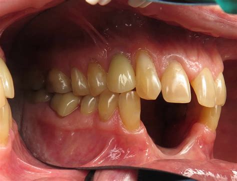 Bone Grafting or No Bone Grafting? - Ramsey A. Amin DDS