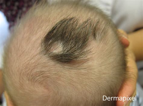 Dermapixel: Aplasia cutis congénita: cuando falta la piel al nacer