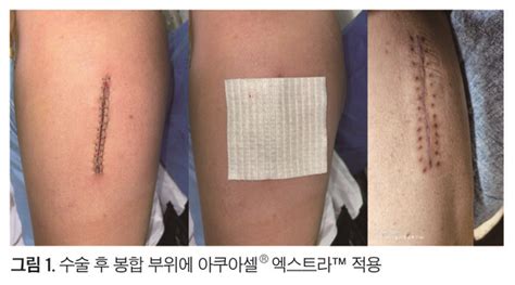 수술 후 봉합 부위에 적용한 아쿠아셀® 엑스트라™의 장점과 효능