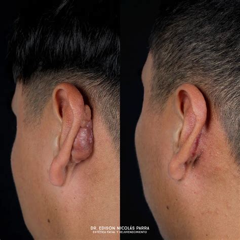Remoção De Queloide Antes E Depois - Eliminación de Queloides en Concepción – Clínica Estética Costanera