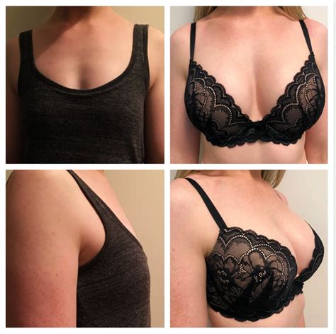 before-and-after-breast-augmentation (1) RESCU