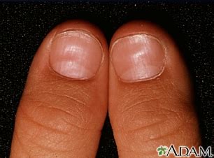 Aggregate 127+ can anemia cause blue nails super hot - ceg.edu.vn