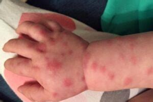 Sepsis In Children | Sepsis Research