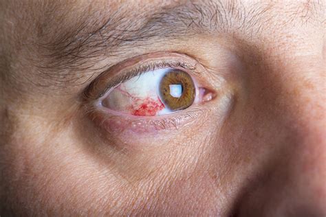 leaking eye blood vessels infoupdateorg