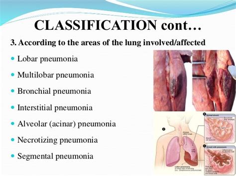 Pneumonia seminar presentaation