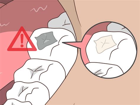 Erosive lichen planus – Artofit