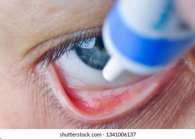 13 Conjunctival Sac Images, Stock Photos & Vectors | Shutterstock