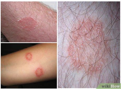 RINGWORM : CAUSES , SYMPTOMS , PREVENTIONS