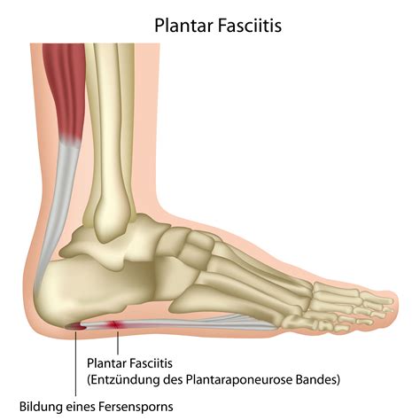 Plantar Faciitis Natural Remedies: Symptoms & Surgery for Plantar ...