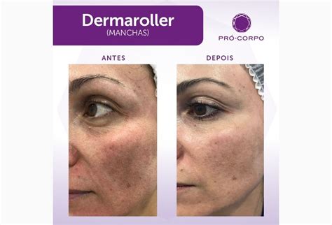 Radiofrequência Microagulhada Antes E Depois - Microagulhamento Com Radiofrequência Antes E Depois - Insights e ...