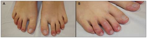 chilblains cmaj