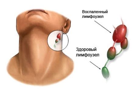 Увеличение лимфоузлов на шее | Лечение, симптомы, причины