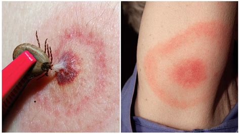Η ασθένεια Lyme ή η βρορελίτιδα που προκαλείται από τσιμπούρια ...