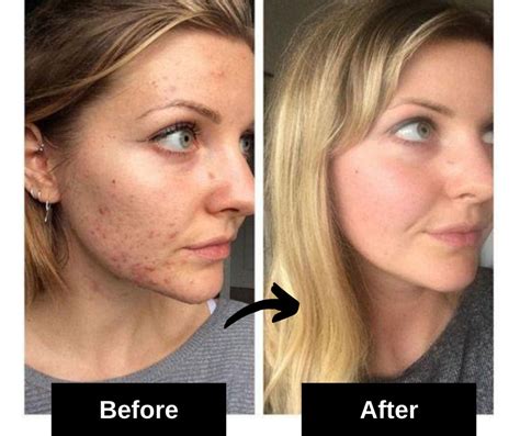 15 Most Effective Home Remedies For Acne Scars | Fabbon