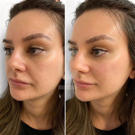comprehensive guide  cheek fillers cosmetic connection