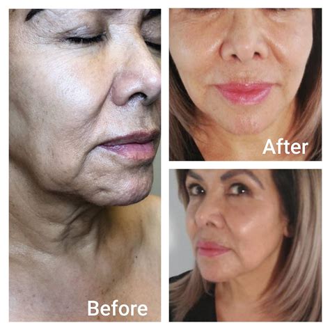 Fibroblast Plasma Skin Tightening Treatment North Carolina — Izar