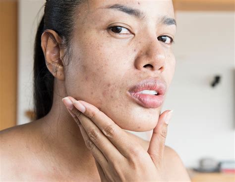 What Does First Signs Of Herpes Look Like - Infoupdate.org