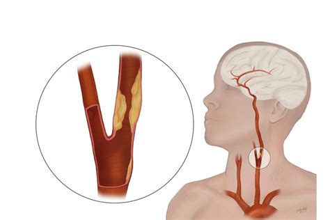 Carotid Artery Disease: Risks, Diagnosis, Treatment - The Eye News
