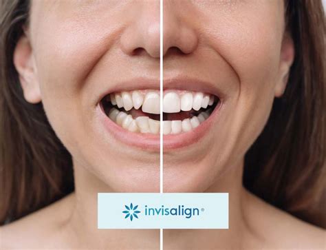 invisalign cost uk pricing guide
