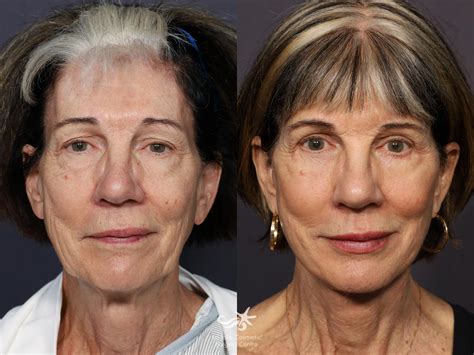 facelift  san diego ca la jolla cosmetic surgery centre