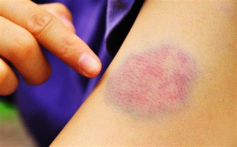 How to get rid of a bruise in 3 days - SIXMD - Vietnamese Online Shop