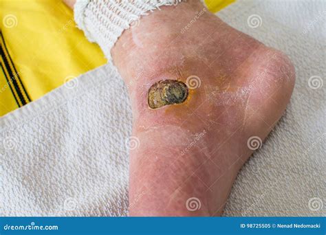 Diabetic Foot stock image. Image of pain, disease, horizontal - 98725505