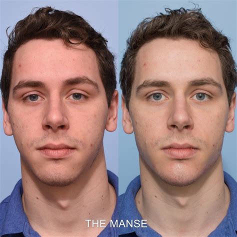 Jaw Filler Before And After Male