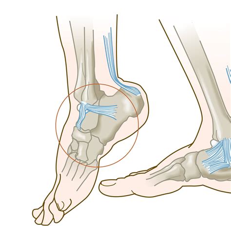 3 STEP DIAGNOSIS- inversion-ankle-sprain – Zlaant