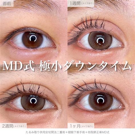 md