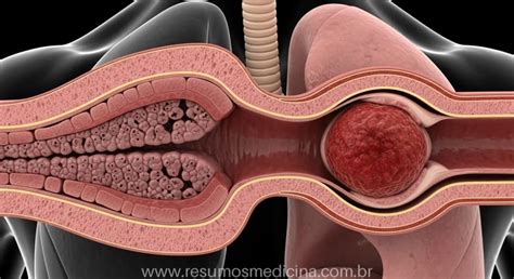 Embolia Pulmonar Sintomas E Causas - Atelectasia e Embolia Pulmonar: Guia Completo de Causas, Sintomas e ...