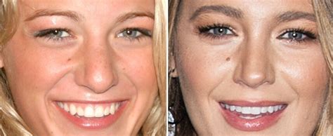 Celebrities Who Have Had Blepharoplasty Before and After