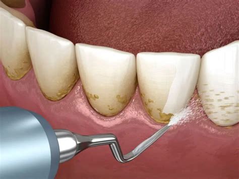 Como Limpar O Tártaro Dos Dentes - Tártaro nos dentes: o que é, como começa e como evitar CIRURGIÃO-DENTISTA