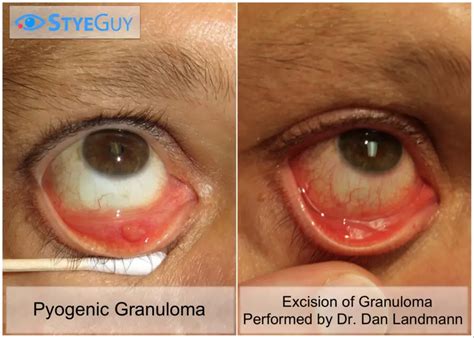 stye surgery  hackensack eye stye removal styeguy