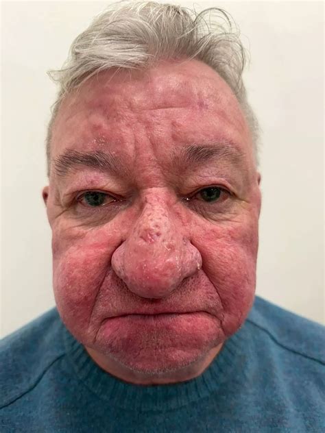 Man unable to kiss wife after one of 'worst cases' of nose growth