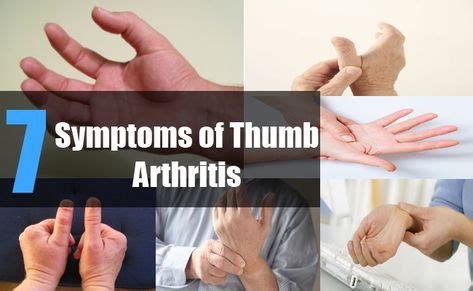 20+ Basal Joint Arthritis ideas in 2020 | arthritis, arthritis symptoms, rheumatoid arthritis ...