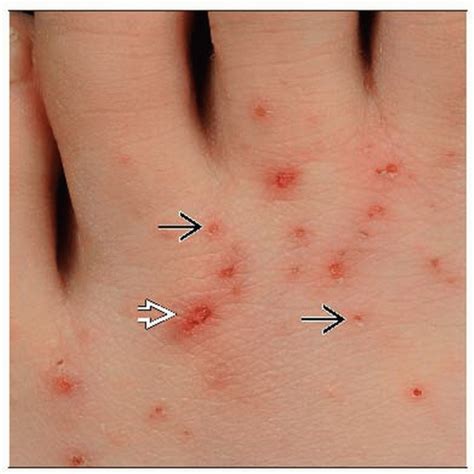 Scabies Diagram