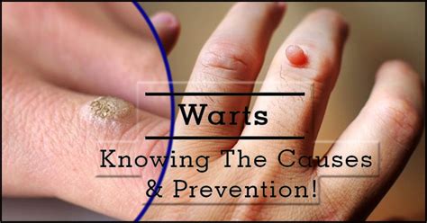 A Wart : Causes, Symptoms & Treatment Options - DaddyDontBlog