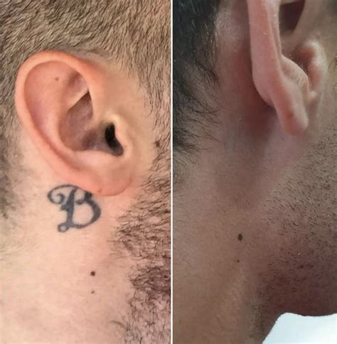 laser tattoo removal aftercare